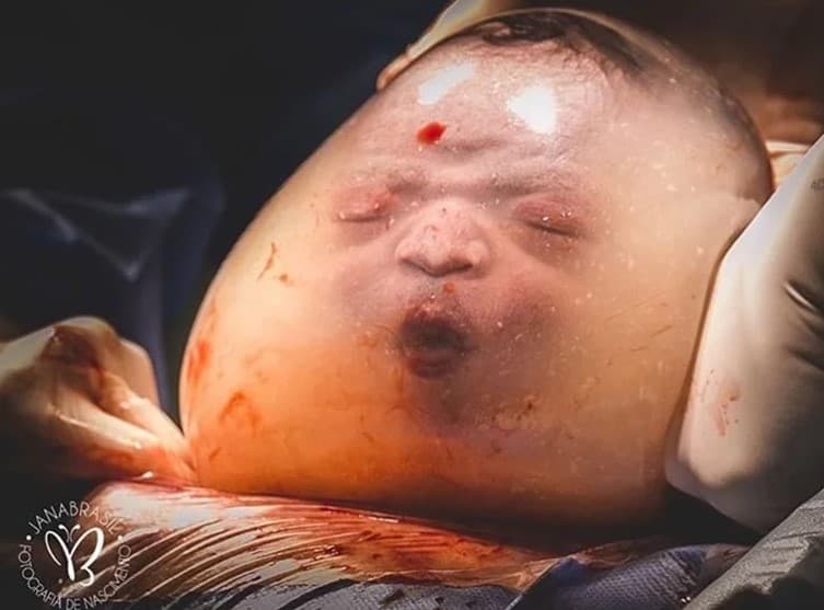 Beba se rodila u amnionskoj vrećici: Plakala sam, prizor je bio divan