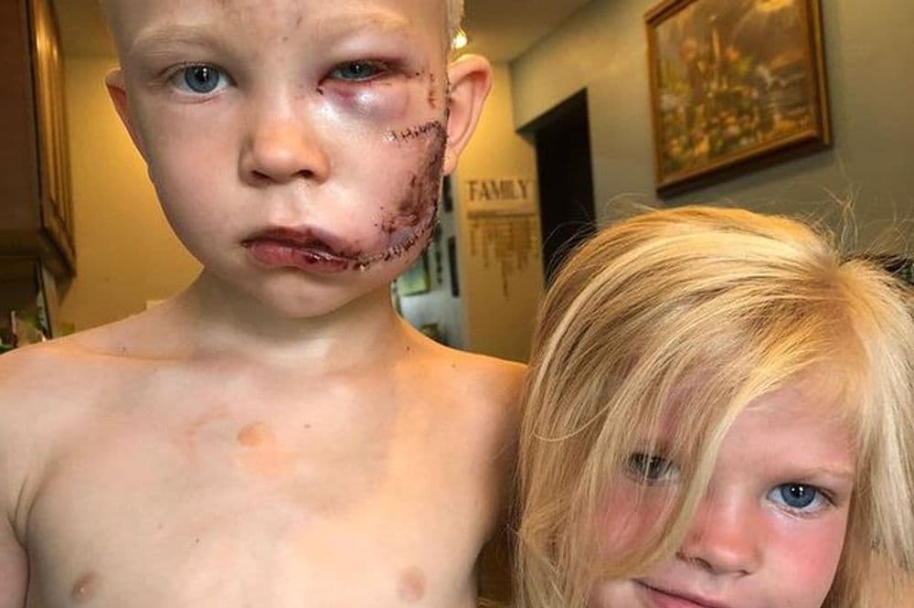 Šestogodišnji heroj spasio sestru od pobješnjelog psa, dobio je 90 šavova