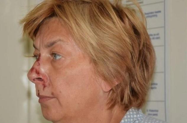 Na Krku pronađena žena s povredama, ne sjeća se svog identiteta
