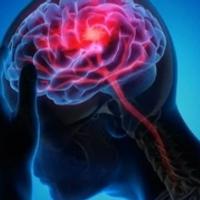 Naučnici razvili novu metodu kojom se smanjuje rizik od moždanog udara